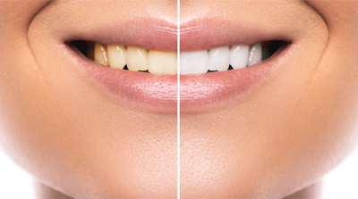 before and after